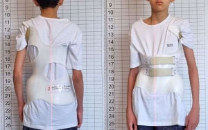 Colete 3D, Colete para Escoliose, Colete 3D para Escoliose