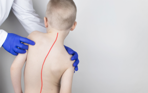 Como saber se meu filho tem Escoliose? Escoliose em adolescentes