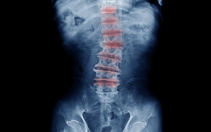 Doenças degenerativas na coluna